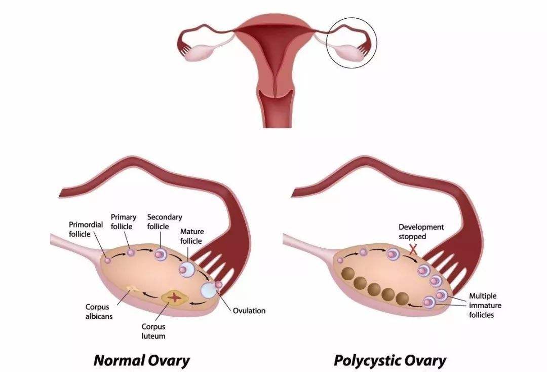 宫外孕成新晋孕产的四种习惯,宫外孕早期和先兆流产