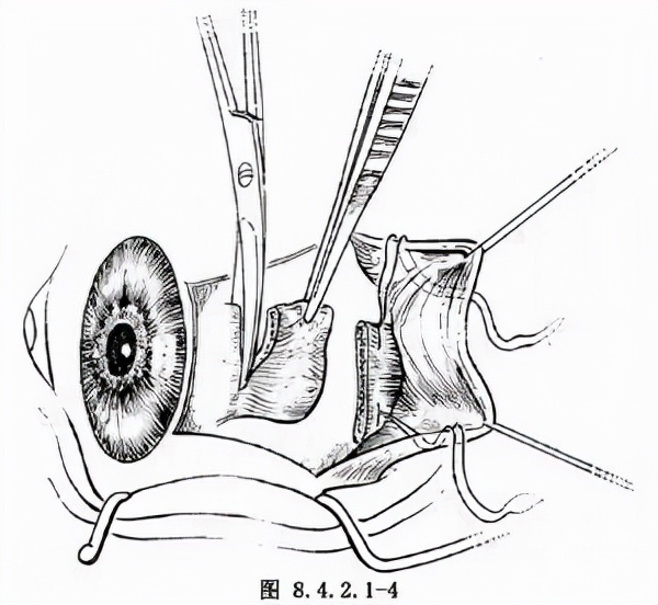 内隐斜最佳矫正方法,内隐斜视配镜