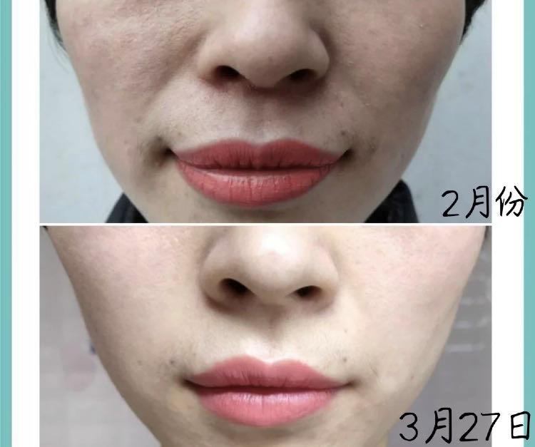 长期吃胶原蛋白保健有什么副作用,女人长期服用胶原蛋白会有皱纹吗