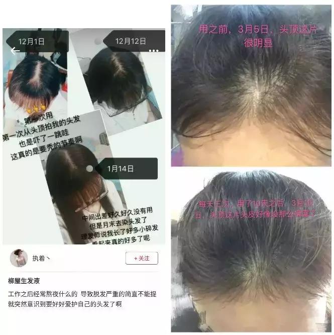发际线高头发稀疏掉头发怎么拯救,发际线后移的头发还能长出来么