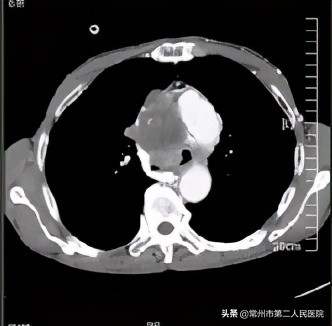 常州二院射频消融手术专家,常州二院的微创手术怎么样
