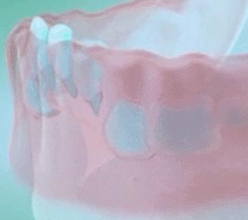 如何预防宝宝的双排牙,换牙出现双排牙不齐怎么办