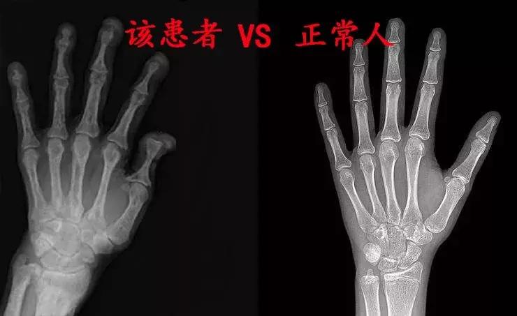 透析病人肌酐急速上升为什么,透析三次肌酐从1100降到500多