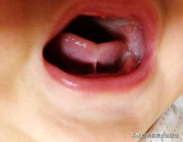 鍝轰钩鐨茶鐤肩棝,鍝轰钩鏈熶钩鑵虹値涔冲ご鐨茶