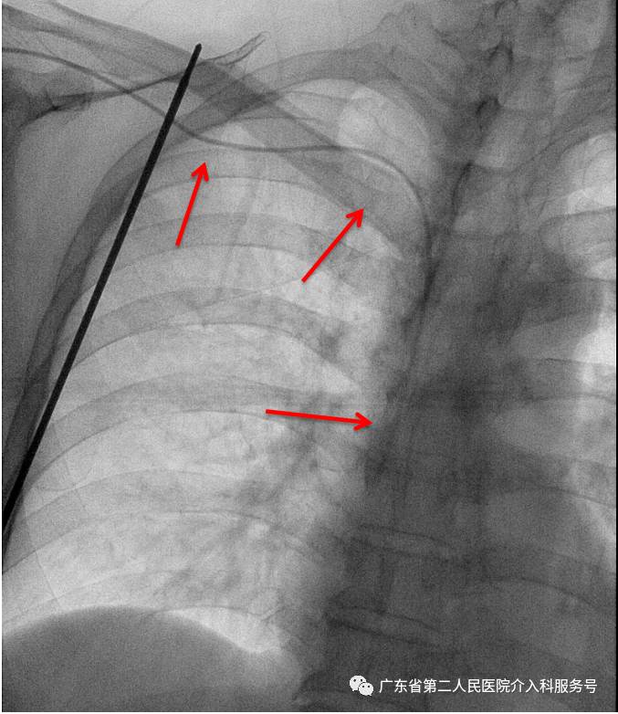 输液港能多次做吗,输液港可以重复使用吗