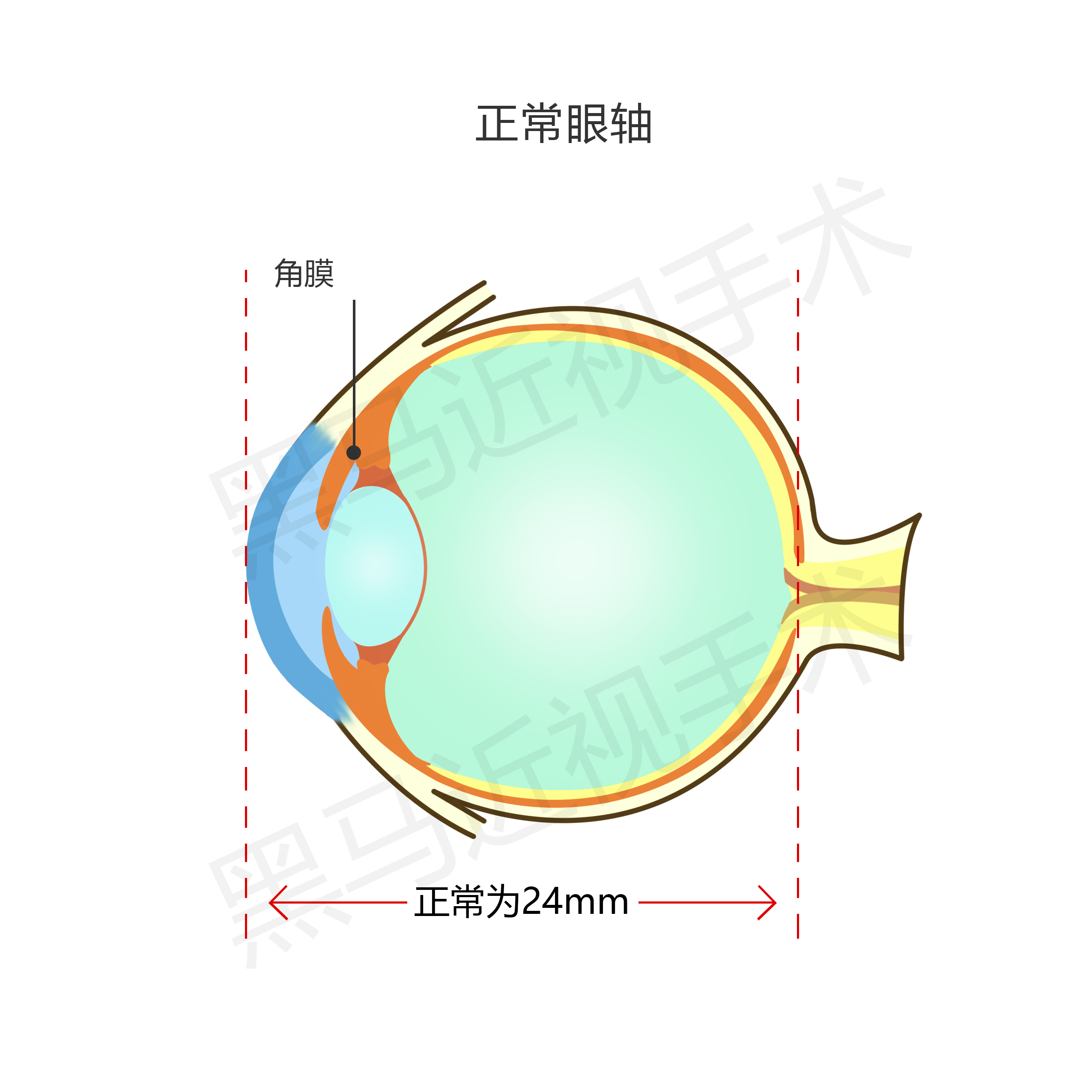 高度近视眼1000度视频,高度近视1000度会瞎吗