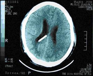 孩子的头偏小怎么办,孩子扁头偏头