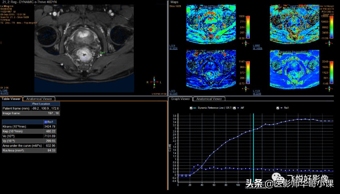 「飞利浦磁共振技术」DCE技术原理及应用（二）