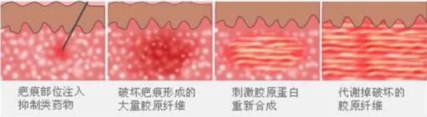 鼻子打疤痕软化针疼吗,打疤痕软化针注意事项