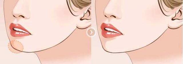 玻尿酸胶原蛋白的功效与作用,玻尿酸的功效医美