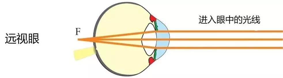 为什么说近视不是看电视造成的,为什么说近视治不好