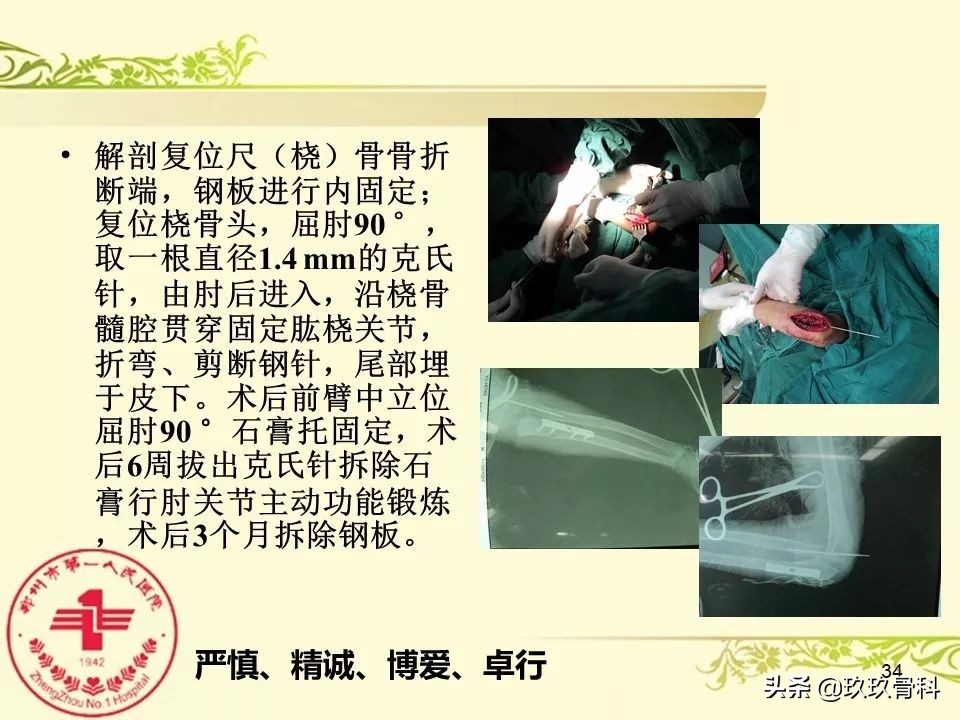 孟氏骨折功能训练多久能恢复正常,孟氏骨折中医能治吗