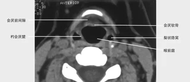 喉部病变做核磁还是ct,耳鼻喉科常见病影像诊断