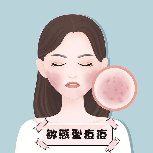 青春痘的中医辨证及治疗,青春痘的中医疗法视频