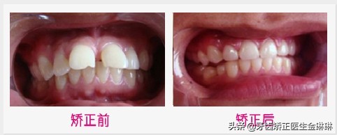 牙齿正畸前后变化大吗？带你看牙齿矫正变化图