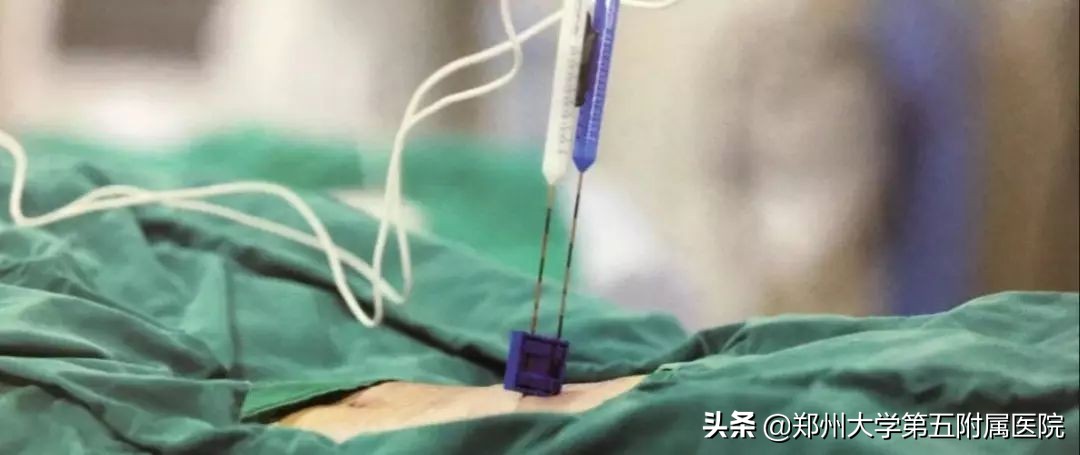 河南省肿瘤医院射波刀治疗胰腺癌,郑大第一附属医院治疗胰腺癌