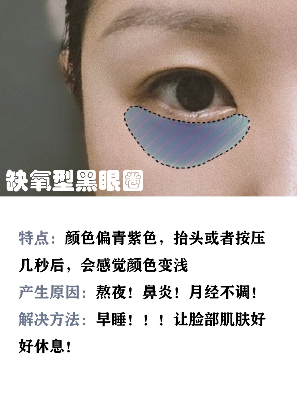 这7个方法迅速缓解你的黑眼圈,如何才是解决黑眼圈的最好方法