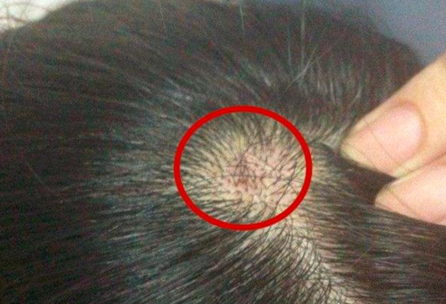 头皮长疙瘩治疗,头皮上的小疙瘩怎么去除