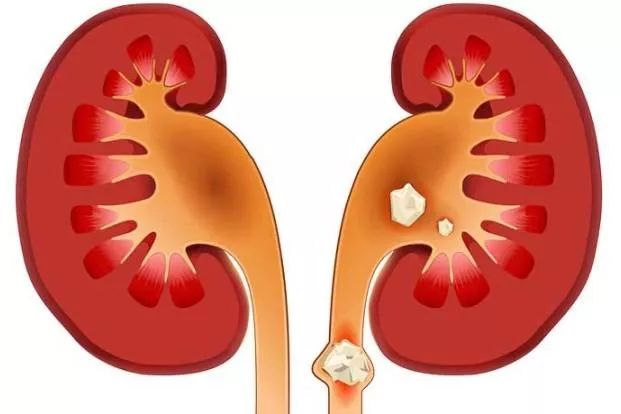 肾结石病人怎么补钙,补钙会导致肾结石吗