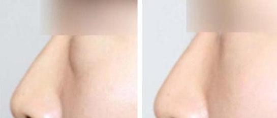 鱼尾纹眼袋怎么去除最有效,去除眼袋鱼尾纹最快最好的方法