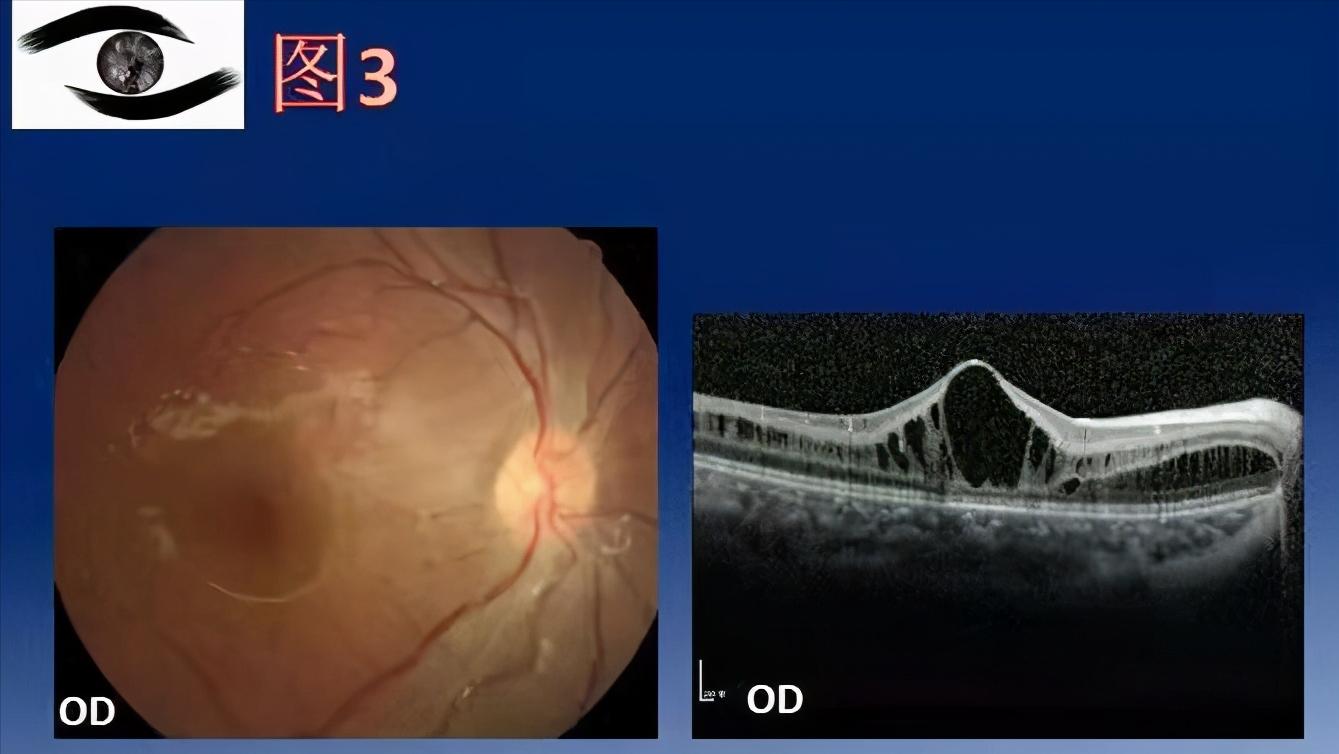 视网膜色素变性症状有哪些,视网膜色素变性会越来越严重吗