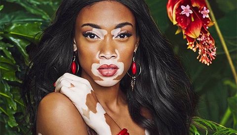 白癜风不扩散好治疗吗,白癜风不扩散可以不治疗么