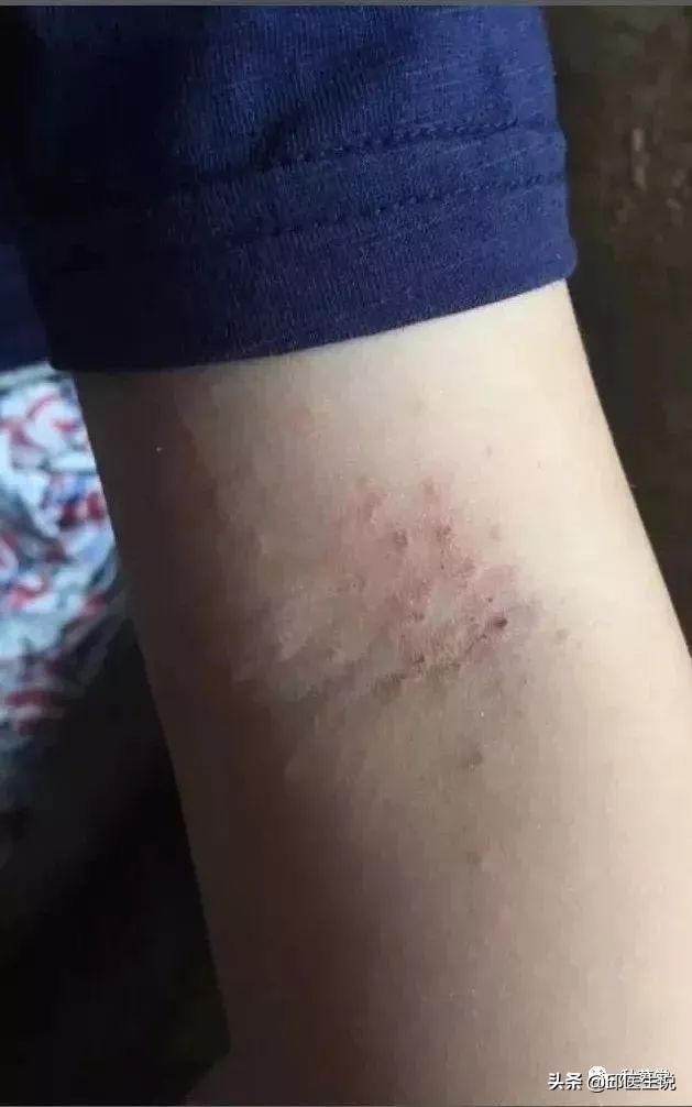 皮肤瘙痒的外洗中药,中药外洗治疗顽固性皮肤瘙痒