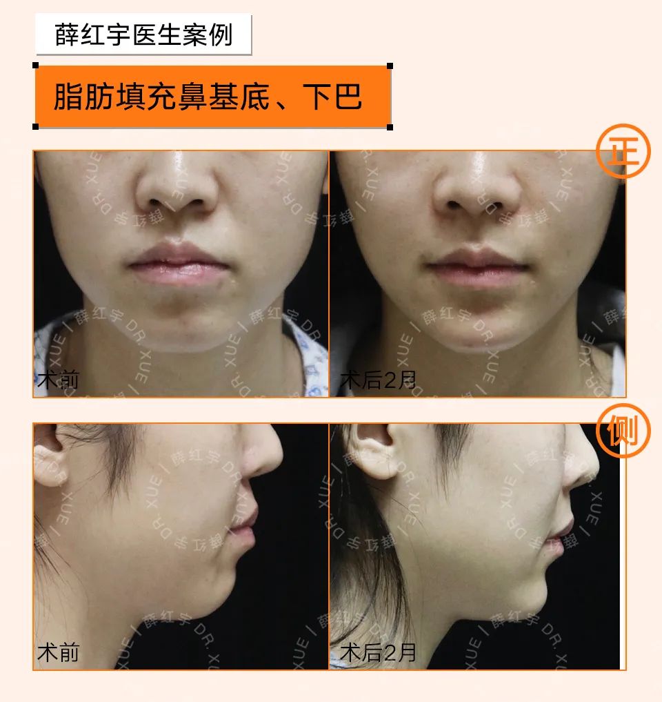 法令纹怎么改善脸部衰老,改善法令纹按摩手法视频