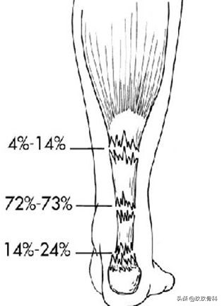 跟腱断裂的确诊方法,超详细跟腱断裂的诊断与治疗