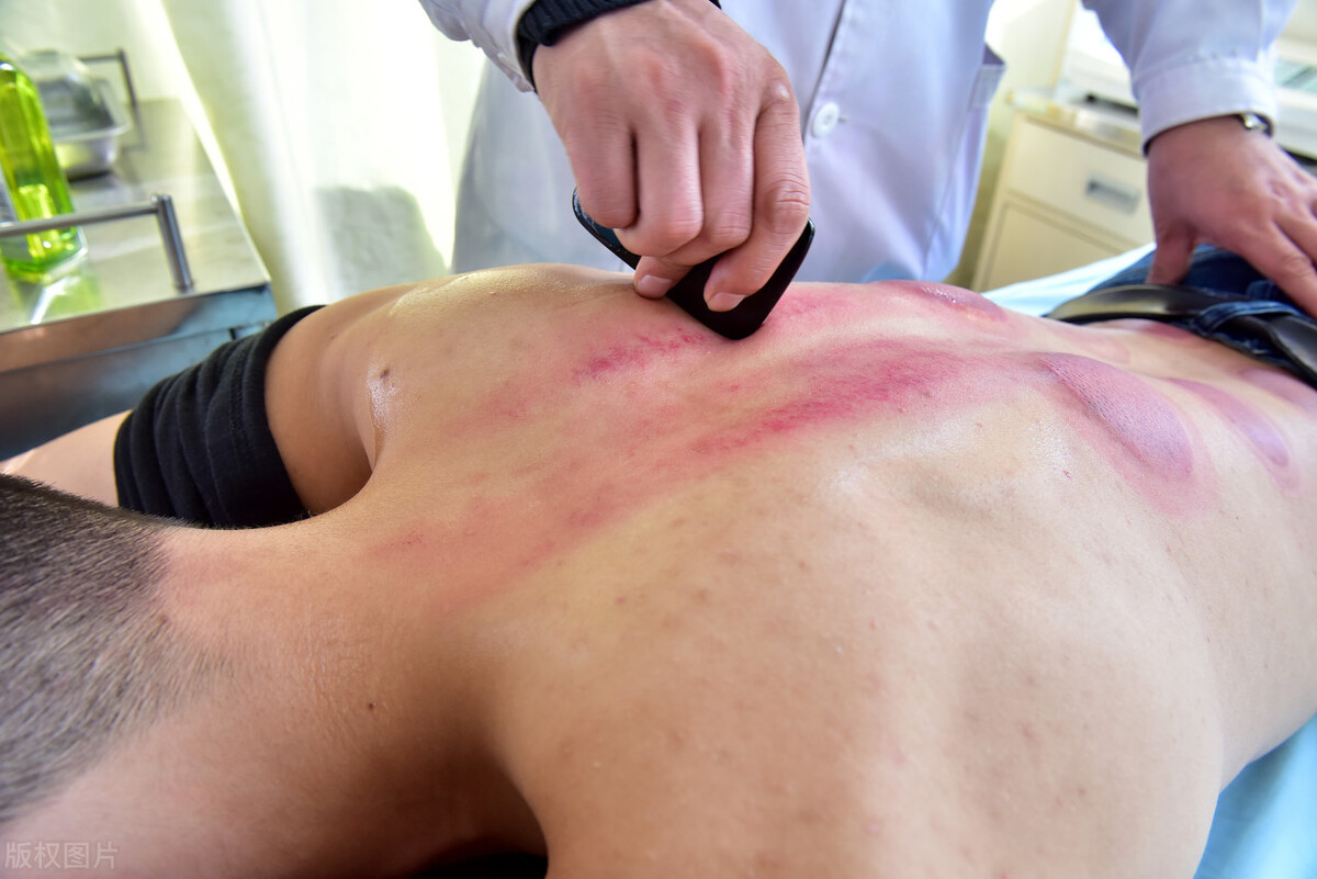 刮痧后一片红一会就散了,刮痧完背部都是红紫色说明什么