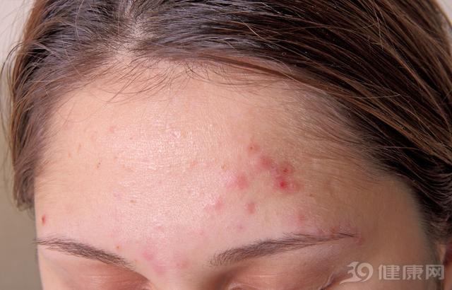 脸上特别多螨虫会怎么样,脸上螨虫是怎么搞的