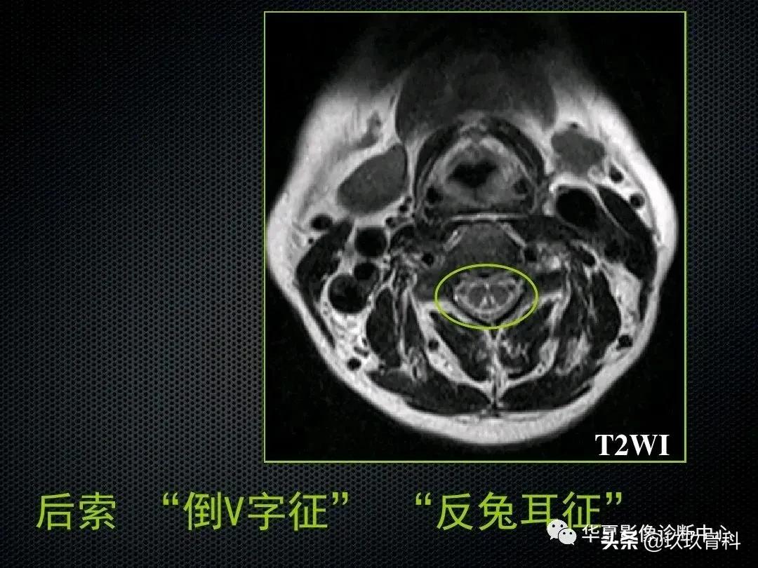 颈椎病脊髓变性mri表现,脊髓亚急性联合变性的诊断
