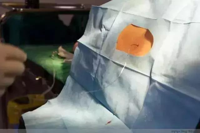 剖腹产术后4小时恢复知觉正常吗,剖腹产术后咳嗽怎样快速恢复