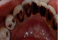 牙结石要怎么处理才干净,人牙结石处理过程