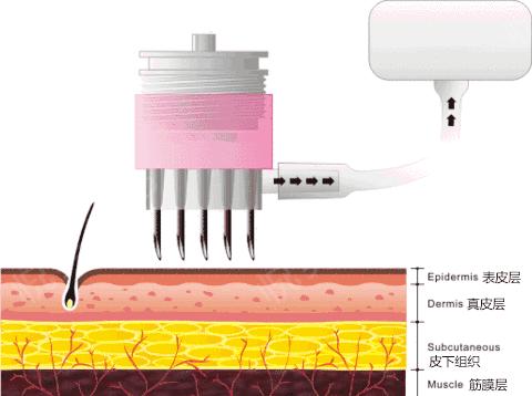 水光针真的比面膜好吗,1次水光等于1000张面膜