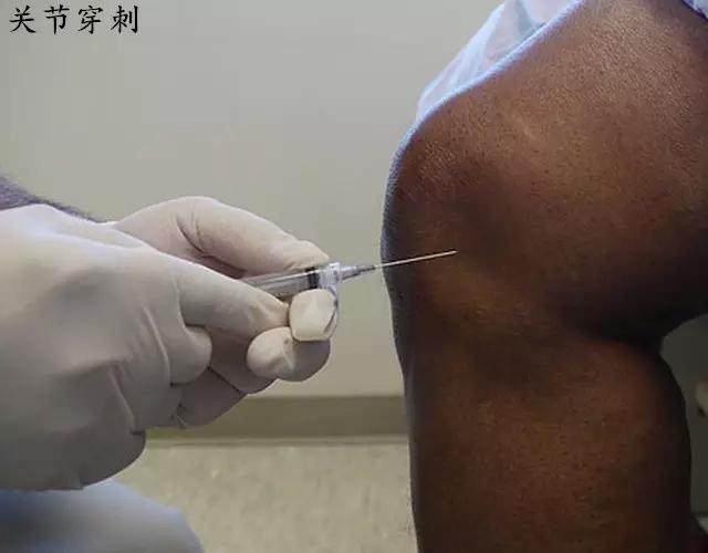 关节积液滑膜炎怎么治疗好得快,滑膜炎膝盖积水怎么治疗好得快