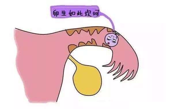 孕妇宫外孕,宫外孕发生在卵巢上症状