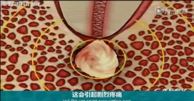 上牙龈上火突出一个鼓包,牙龈肿胀鼓包上火了吗