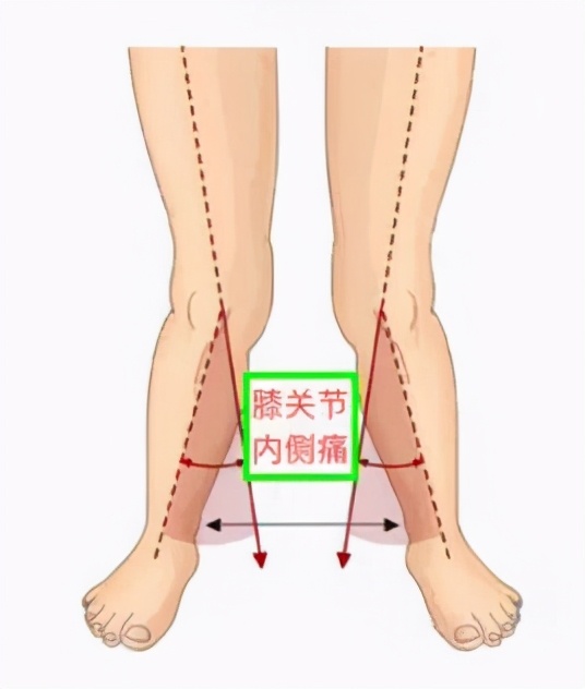 足弓塌陷的矫正动作懒人法,足弓改善动作