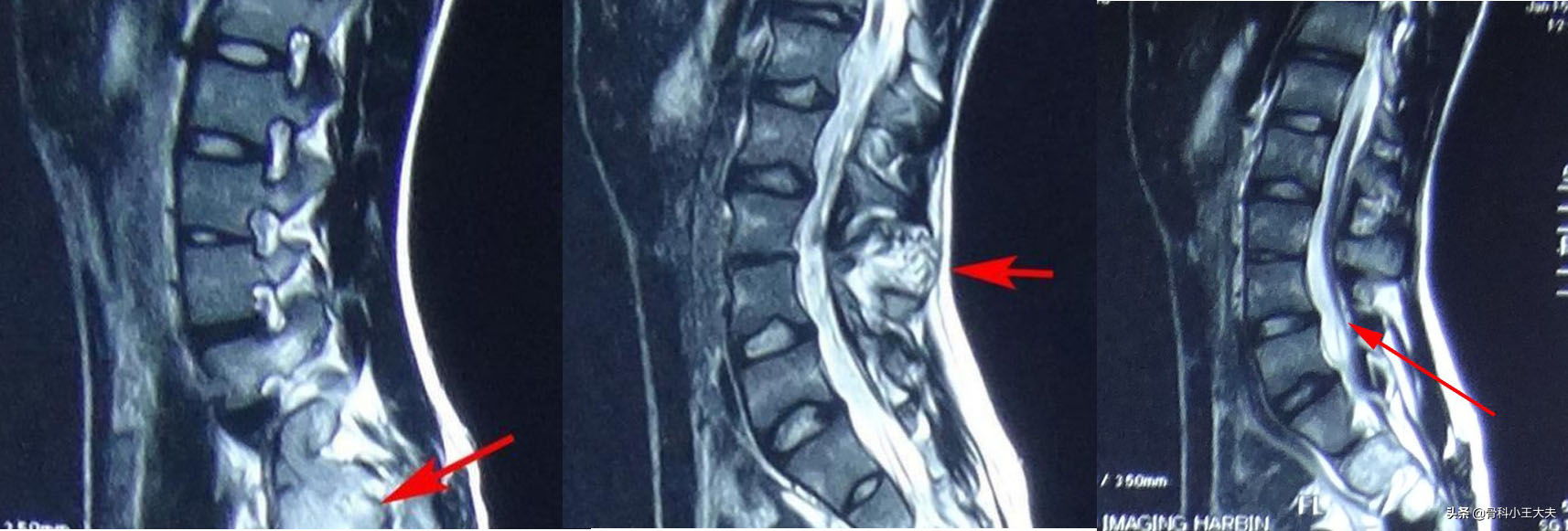 老年人脊柱歪了怎么办,成年人脊柱歪了的危害