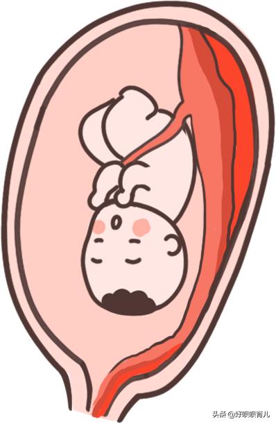 二胎妈妈提前破水,二胎妈妈见红后立即去医院吗