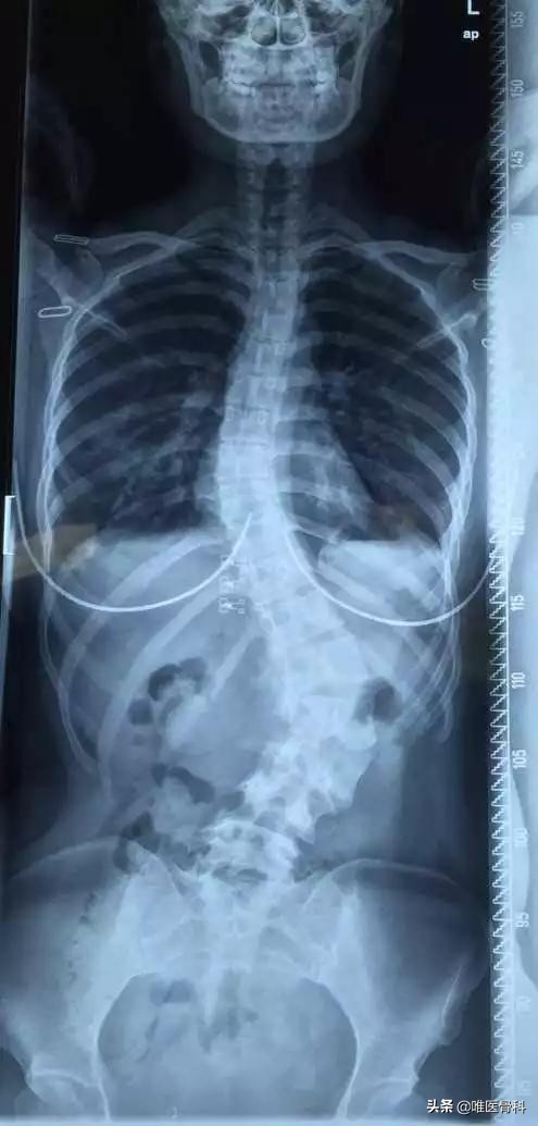 孩子高低肩的原因及危害,儿童高低肩的原因及危害