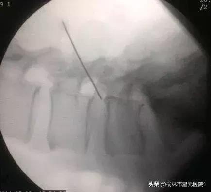 榆林佳县治疗腰椎间盘突出,榆林腰椎间盘突出最有效治疗