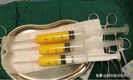 面部填充后吃什么对脂肪存活有利,脂肪填充多久脂肪存活稳定