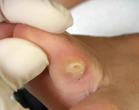 鸡眼是怎么形成的,鸡眼是怎样形成的