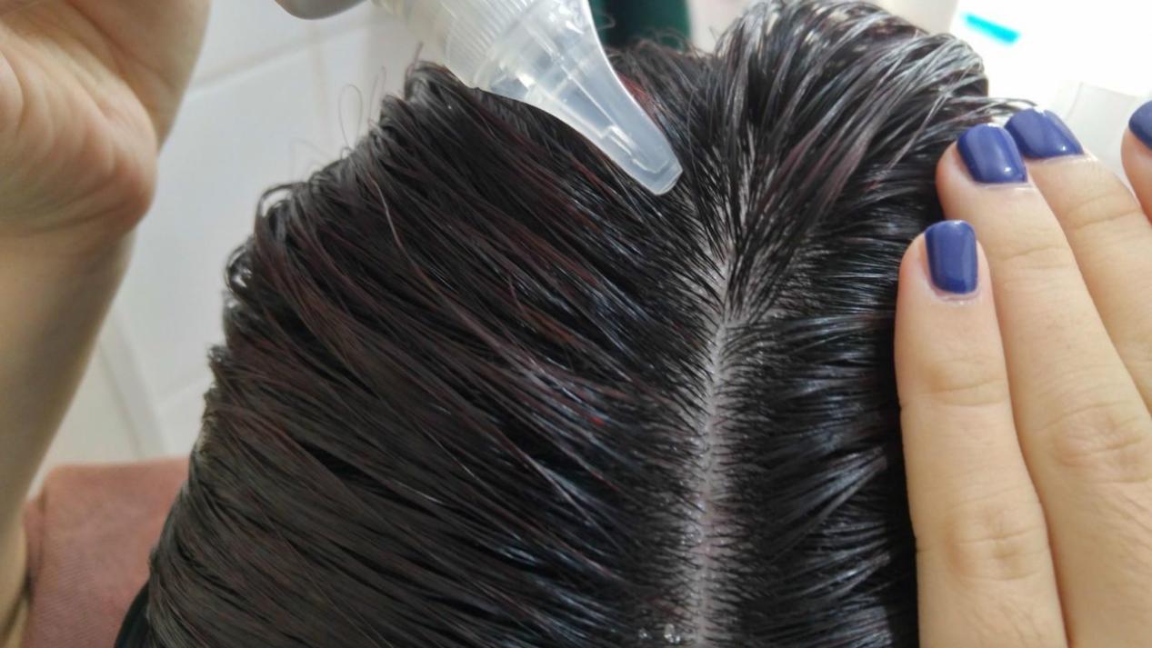 头皮屑反反复复的怎么治疗,头皮屑反反复复是什么原因造成的