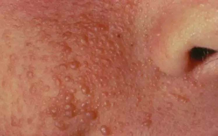 身上长小肉粒可以抠掉吗?小肉粒“偏爱”这些人