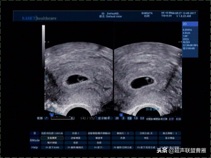 3毫米卵黄囊未见胎芽正常么,40多天的卵黄囊