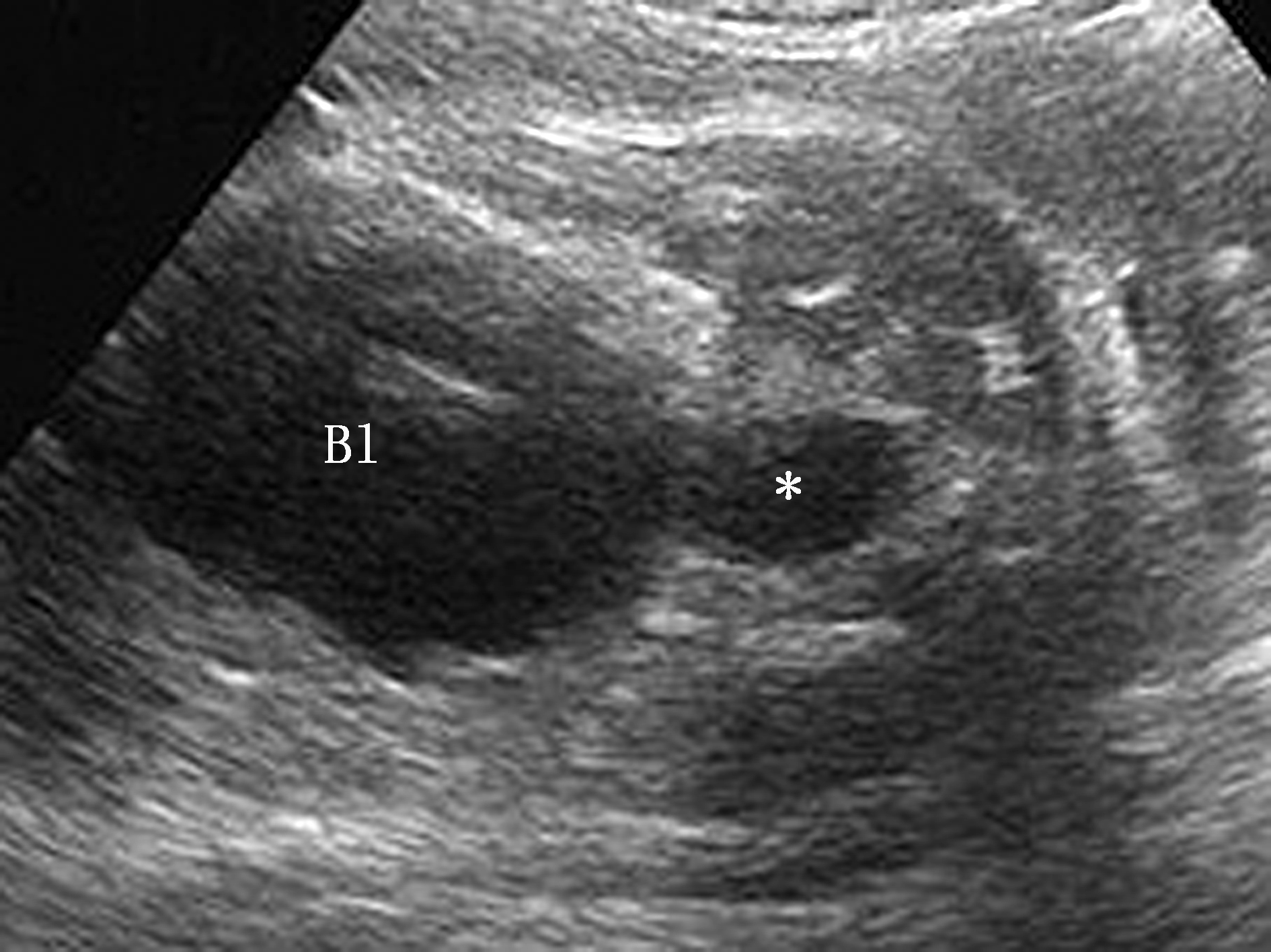 胎儿尿路梗阻肾积水越来越多,胎儿双肾梗阻