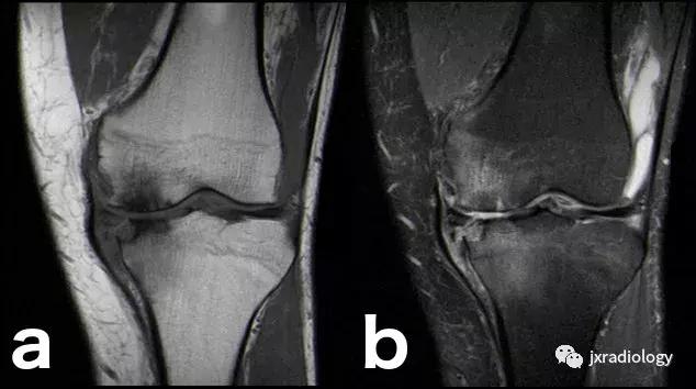 磁共振天天诊断骨髓水肿，但您知道原因吗？